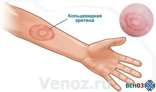 як лікувати ревматизм серця