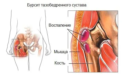 як лікувати бурсит тазостегнового суглоба
