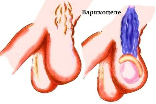 як вилікувати варикоз 2 ступеня