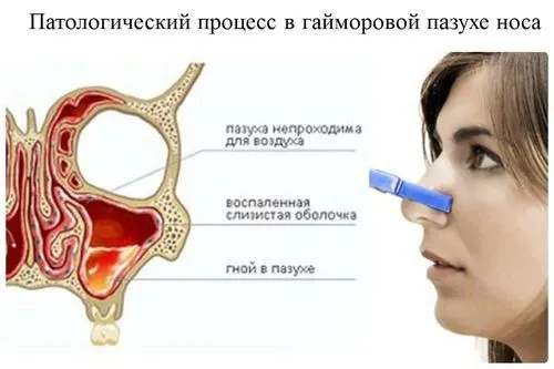 хронічний гайморит в стадії загострення