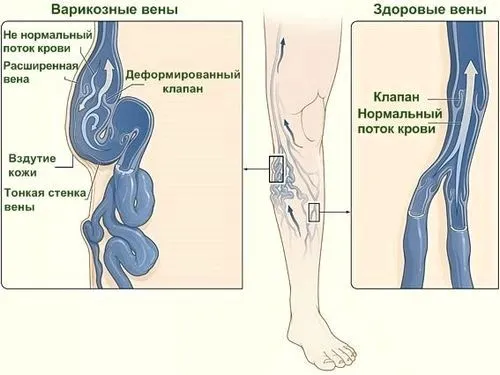 варикоз нижніх кінцівок симптоми лікування