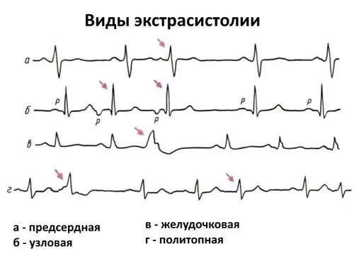 як лікувати функціональну екстрасистолію