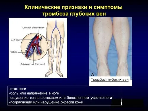біль в ногах при варикозі симптоми