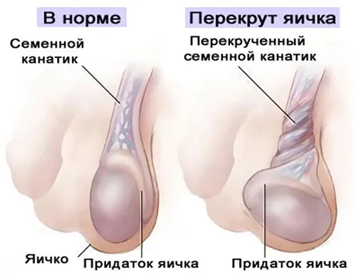варикоз нижніх кінцівок симптоми лікування