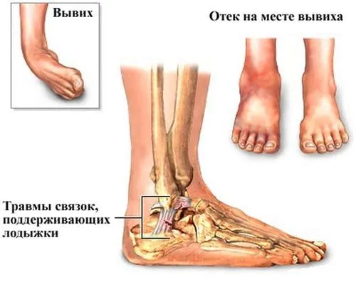 травма та забій голеностопа