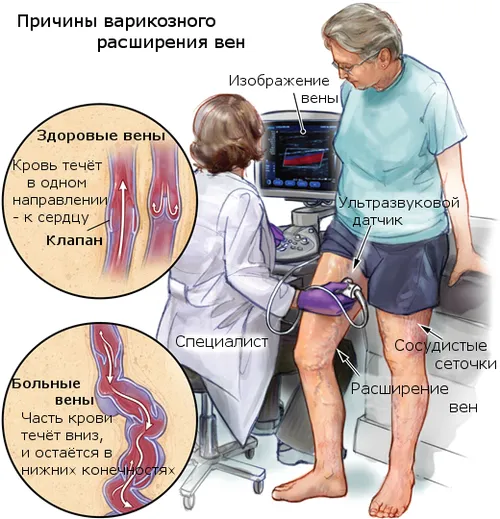варикоз нижніх кінцівок симптоми лікування