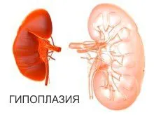як лікувати гіпоплазію нирки
