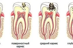 вилікувати карієс народними засобами