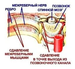 як лікувати невралгію голови