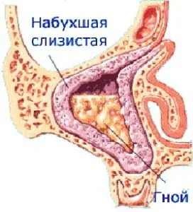 запалення