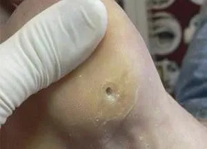 мозоль на п'яті що робити