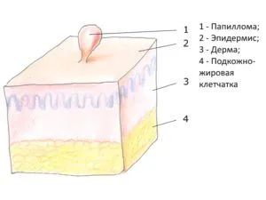 як вилікувати вірус папіломи людини у жінок