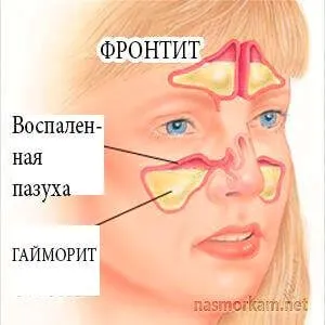 прокол при фронтите