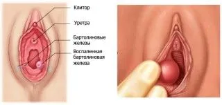 як лікувати кісту бартолінової залози народними засобами