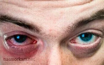 лікування фронтита без проколу в домашніх умовах
