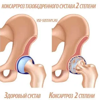 як лікувати деформуючий артроз тазостегнового суглоба