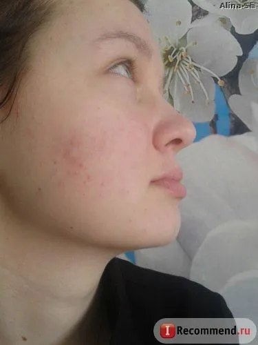 чи довго лікувати демодекоз