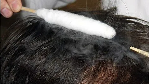 як лікувати себорейний дерматит