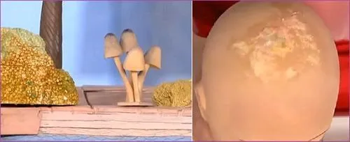 себорейна екзема