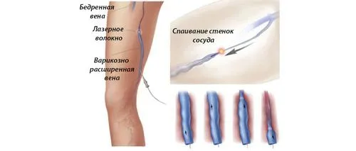 лікувати варикоз лазером
