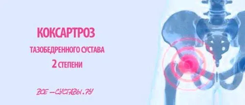 коксартроз кульшового суглоба 2 ступеня лікування