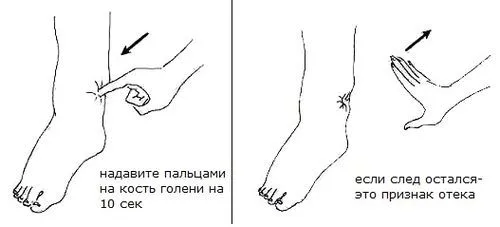 лімфостаз нижніх кінцівок