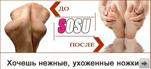 як лікувати натоптиші на пальцях