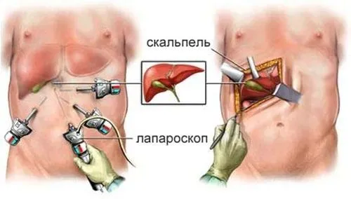 як лікувати хронічний холецистит і панкреатит