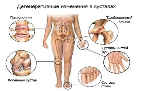 у кого лікувати артроз