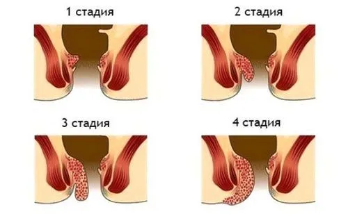 як вилікувати геморой 3 ступеня