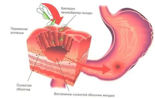 як лікувати шлунок з підвищеною кислотністю