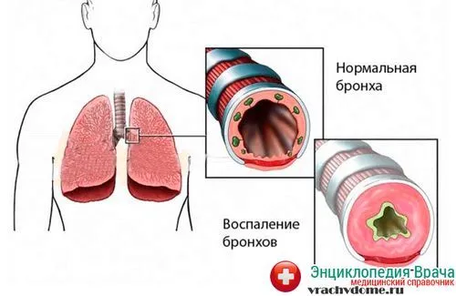 як лікувати астму народним способом