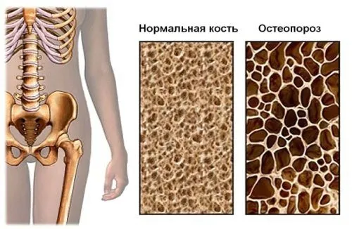 як лікувати остеопороз стегна