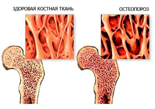 як лікувати остеопороз стегна
