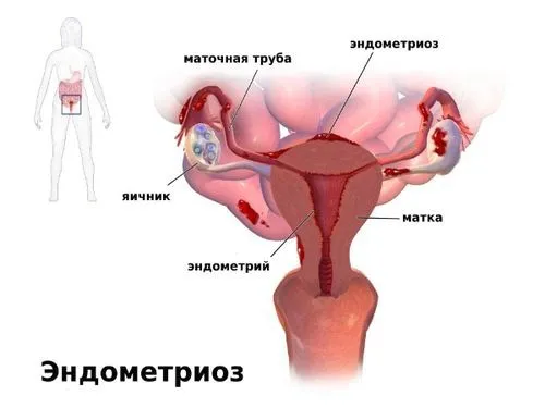 як лікувати ендометріоз Дюфастоном