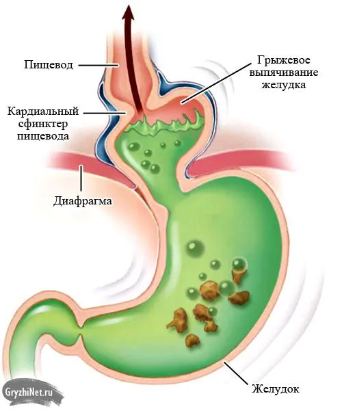 як лікувати грижу шлунку