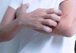 як лікувати алергічну екзему
