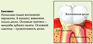 гінгівіт лікування народними засобами