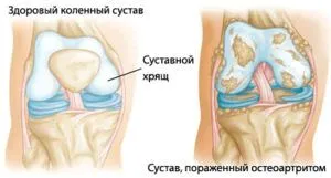 як лікувати артрит суглобів народними засобами