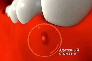 Види стоматиту, різновиди і форми у дітей як лікувати травматичний стоматит