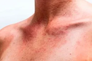 як лікувати штучну кропив'янку