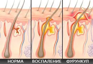 як лікувати фурункул під пахвою