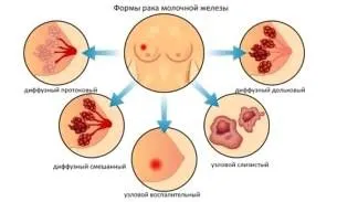 як лікувати рак 2 ступеня