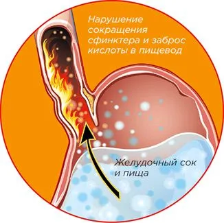 Печіння в шлунку: як будемо лікувати? як лікувати печіння в шлунку