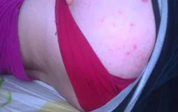 як вилікувати прищі на попі