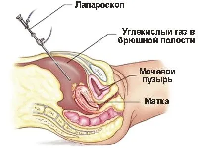 Рак ендометрія: причини, ознаки, симптоми, лікування передраку рак ендометрій передрак матка жінки клімакс узі естроген причини симптоми лікування