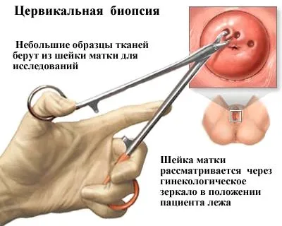 як лікувати рак шийки матки 2 стадії
