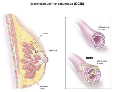 як лікувати рак 2 ступеня