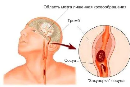 спазм судин лікування