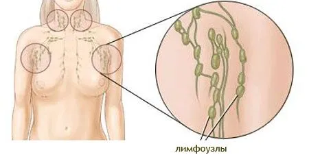лікувати лімфовузол під пахвою
